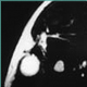 Neurofibromas are growths of Schwann cells that support peripheral nerve networks 